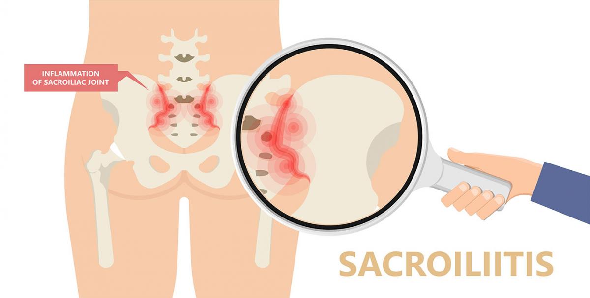 Facet Joints Versus SI (Sacroiliac) Joints