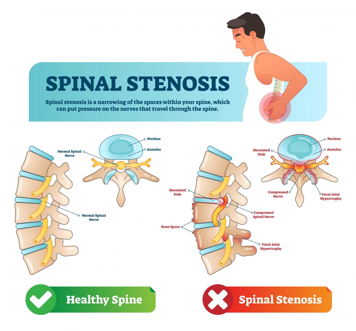 What Are the Different Treatments for Spinal Stenosis?